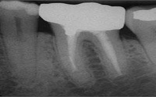 Radiograph of a tooth